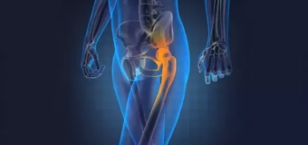 Hip Replacement – Hip a major weight bearing point in the human body