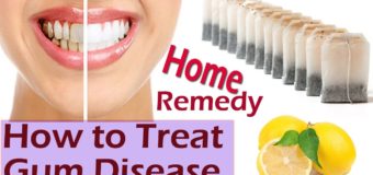 5 Natural Ayurvedic Home Remedies For Bleeding Gums