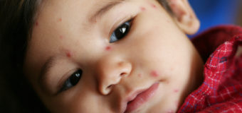 Chickenpox: 8 Natural Home Remedies To Get Rid Of Chickenpox